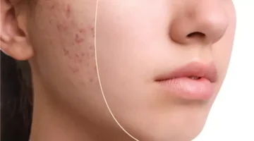 حب الشباب في الثلاثينيات: أهم 5 أسباب وطرق علاج فعالة للسيدات